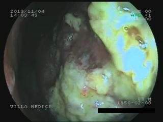 Gyomor Cardia Tumor